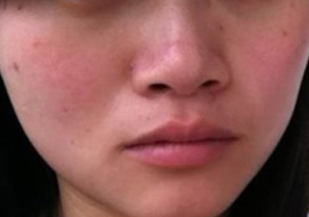 如何判斷自己是不是敏感性皮膚？